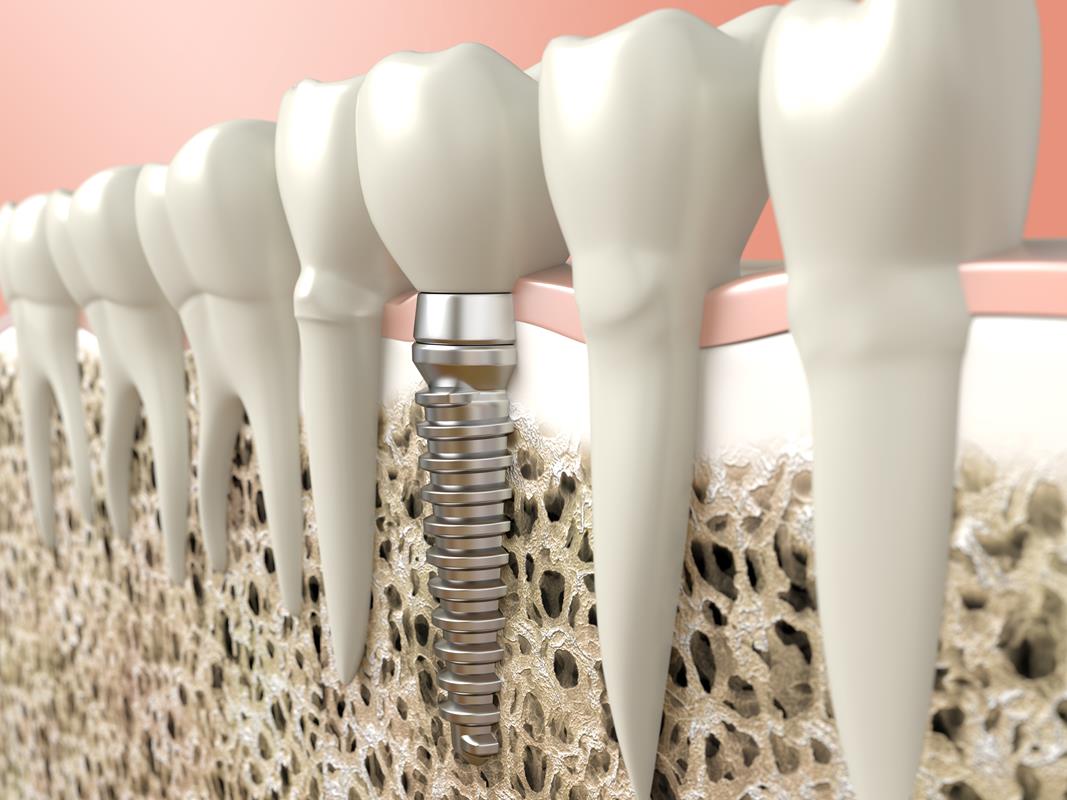 Dental Implants  Liberty, MO 